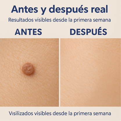 ByeWart Pro: Removedor de Verrugas que funciona!