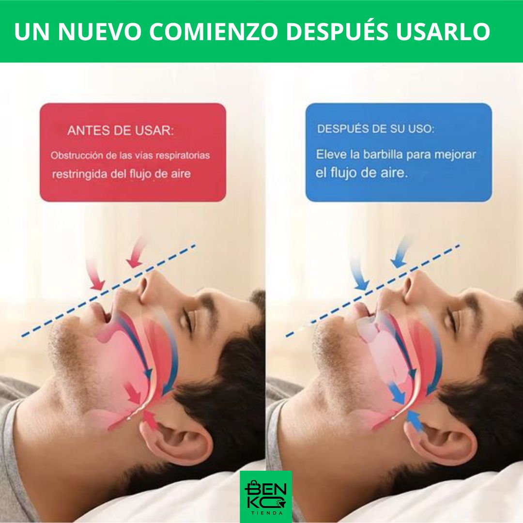 3 en 1: Placa Anti Bruxismo, Apnea y Ronquido